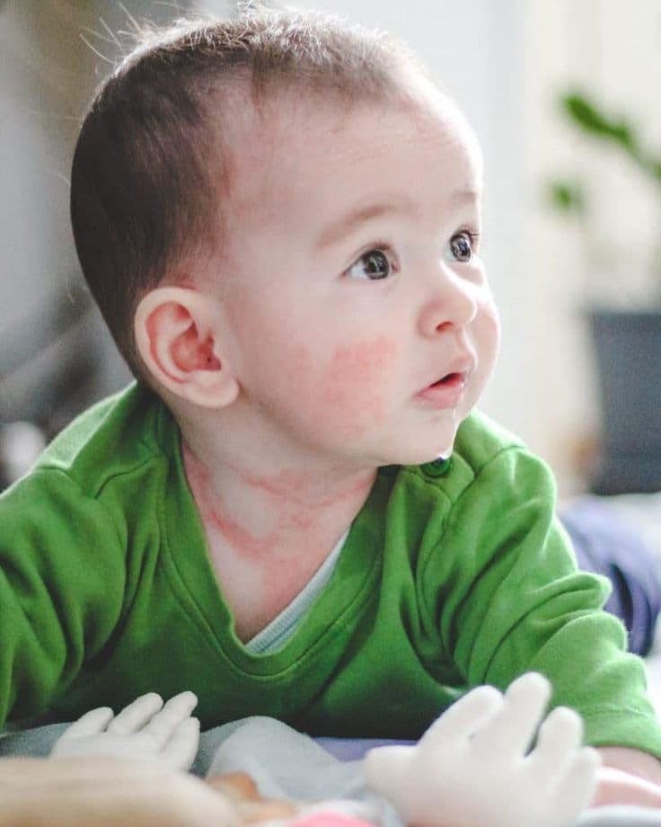 Alimentação e APLV